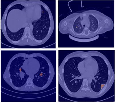 A proposed methodology for detecting the malignant potential of pulmonary nodules in sarcoma using computed tomographic imaging and artificial intelligence-based models